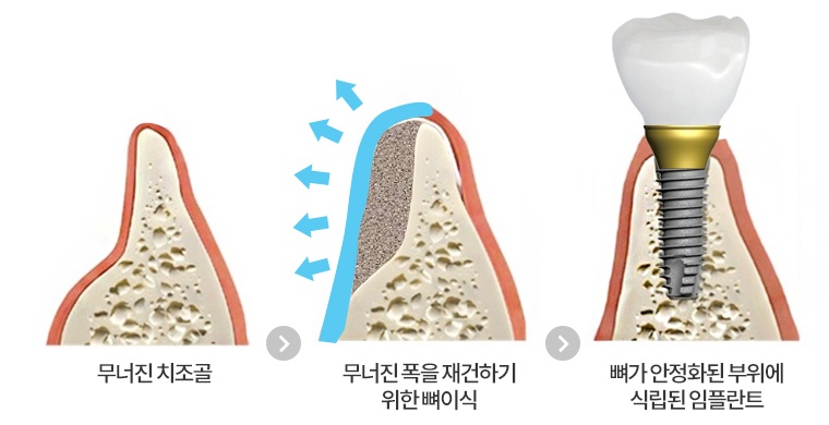 잇몸뼈의 폭이 좁은 경우: 부족한 뼈를 보완하고 임플란트를 식립하는 개념도