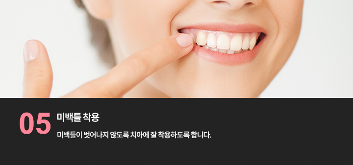 미백틀 착용을 설명하는 미소 참고 사진