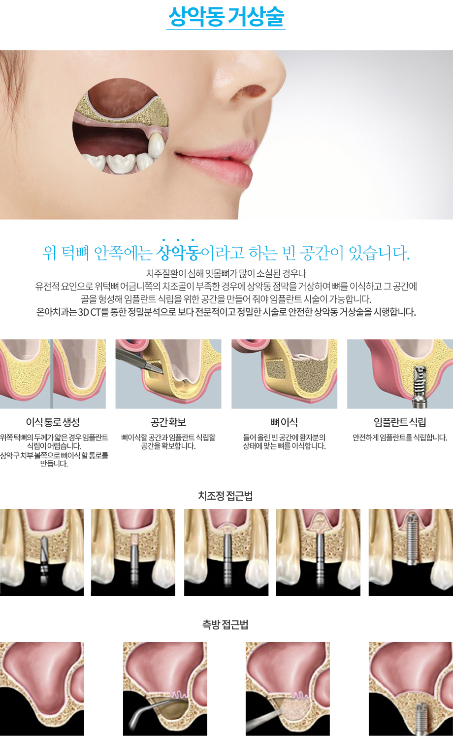 상악동 단면 개념도: 접근 통로 확보