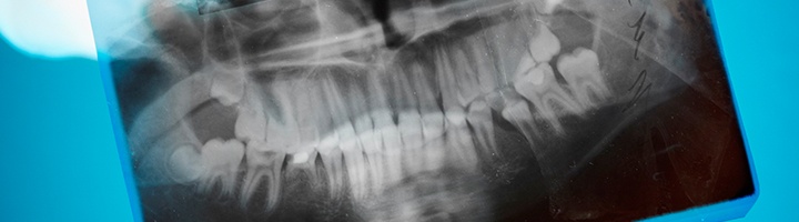 치아 X-ray 참고 사진